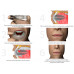 Капа от бруксизма MyOSA TMJ
